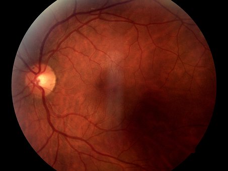 警惕！眼睛的“心梗”—视网膜动脉阻塞的早期信号！